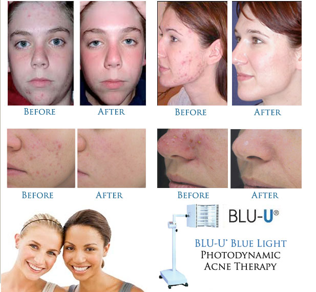 Blue Light Photodynamic Therapy For Acne