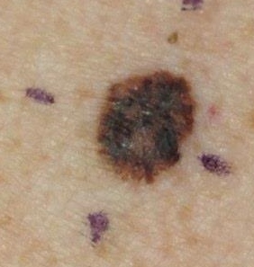 Orleans Dermatology and Laser Therapies - Skin Cancers and Atypical Moles