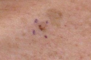 Orleans Dermatology and Laser Therapies - Skin Cancers and Atypical Moles