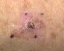 Orleans Dermatology and Laser Therapies - Skin Cancers and Atypical Moles