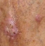 Orleans Dermatology and Laser Therapies - Skin Cancers and Atypical Moles